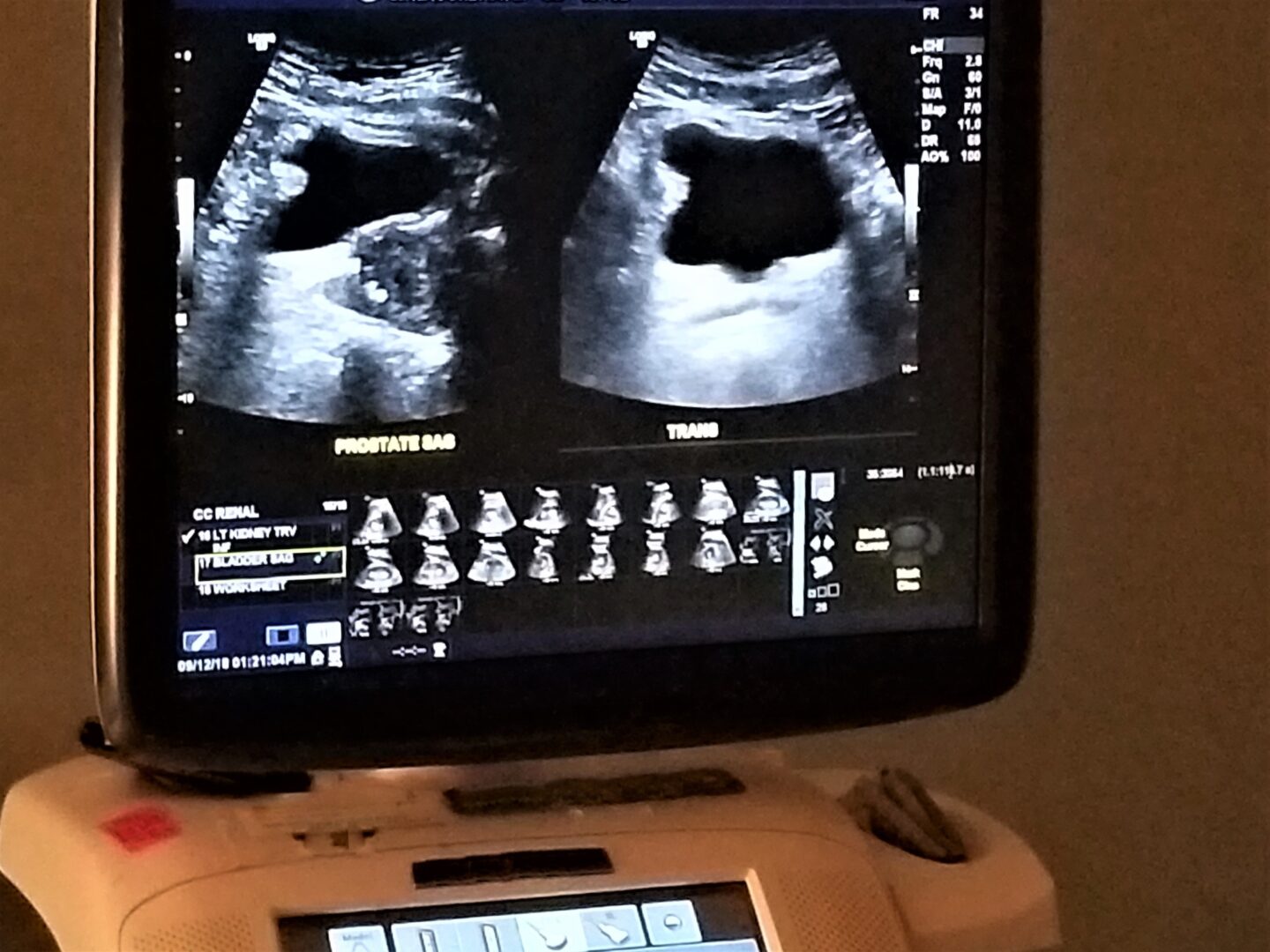 Kidney Ultrasound!